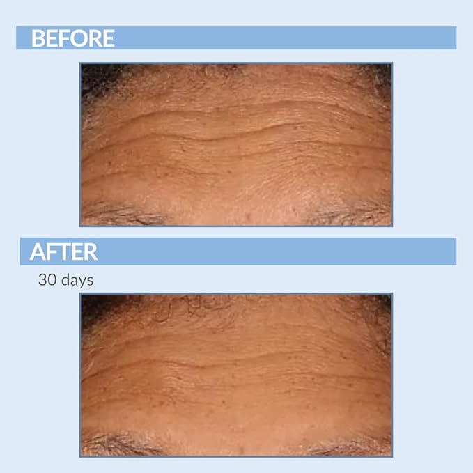 Retinol Fine Lines and Wrinkles Skin Care Set - A Force XR Serum and A Cream XR Moisture Cream for Face - Anti-Aging - Minimize Post Acne Marks - Resurface and Hydrate - Serious Skincare