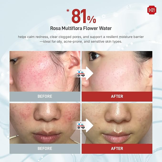 Zeroca 81 Korean Calming Serum for Acne-Prone & Oily Skin – Balances Oil-Water, Soothes Redness, Fades Post-Blemish Marks, Firms & Hydrates (1.01 fl.oz. 30 ml)